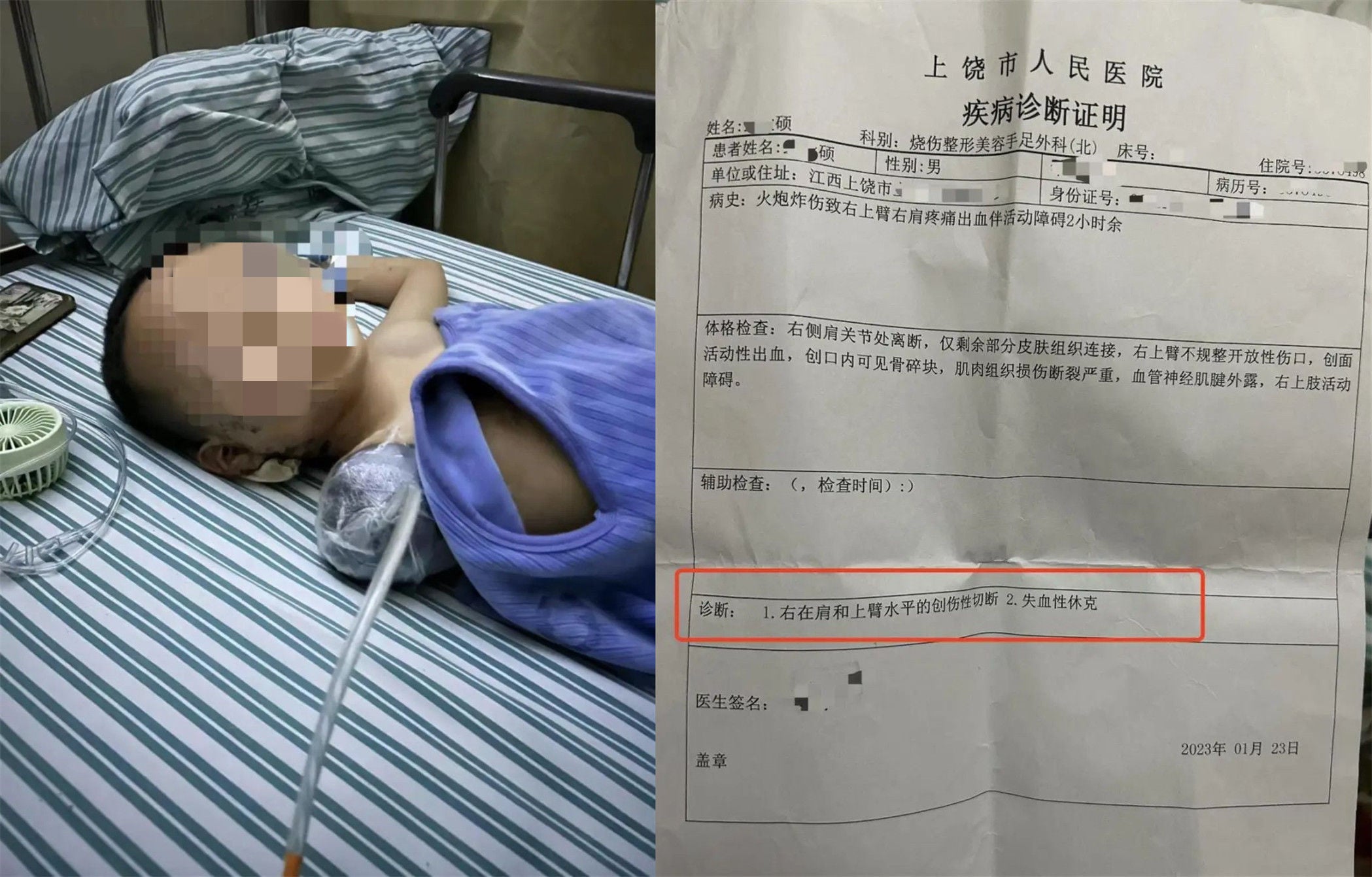 鞭炮误砸男童致右臂截肢 亲戚承诺负责