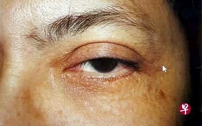 (已签发)柔:狮城二三事:不满眼皮手术效果 老板起诉整形医生索偿被驳回