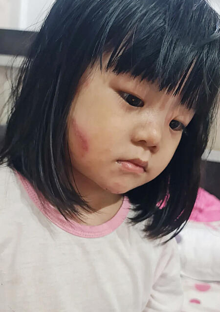 (已签发)柔:狮城二三事:两次骨髓移植失败,4岁血癌童全身如灼伤赴新治疗