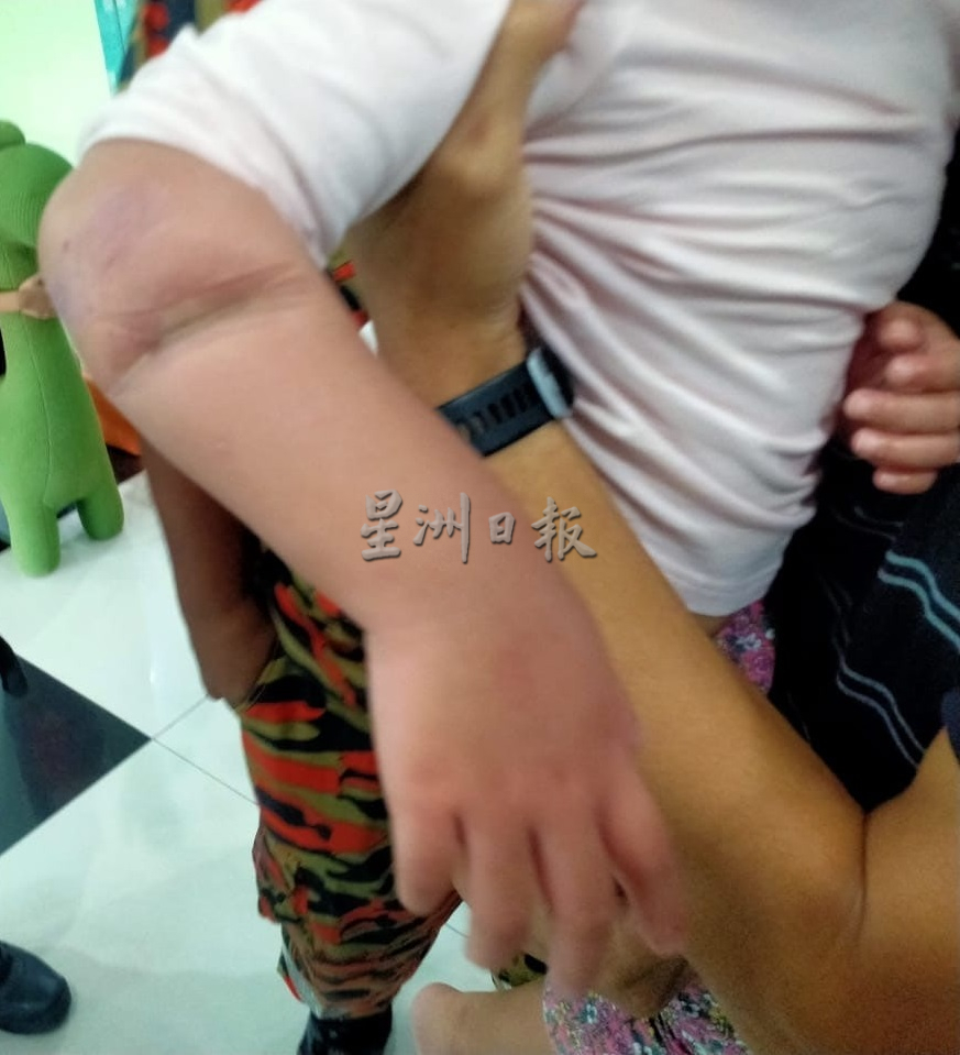 3岁女童手臂被玻璃门夹出印痕 消拯员以特别工具解救