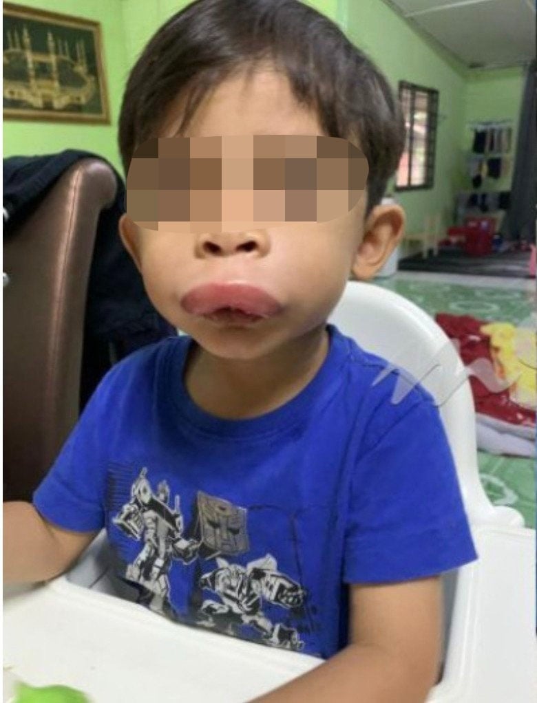 4岁童玩耍撞铁窗现香肠嘴 医生偷笑“只有虫咬才这样”