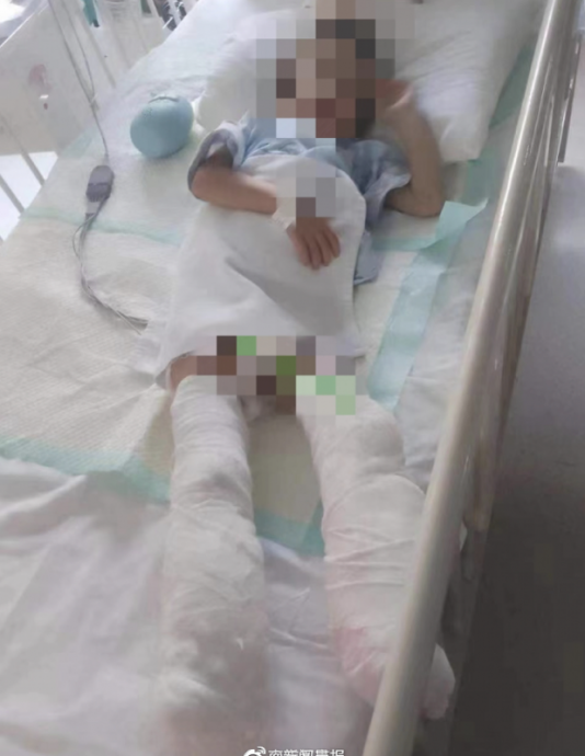 5岁童遭虐到双腿截肢一见亲爸泪:妈妈对我不好!地狱惨况曝