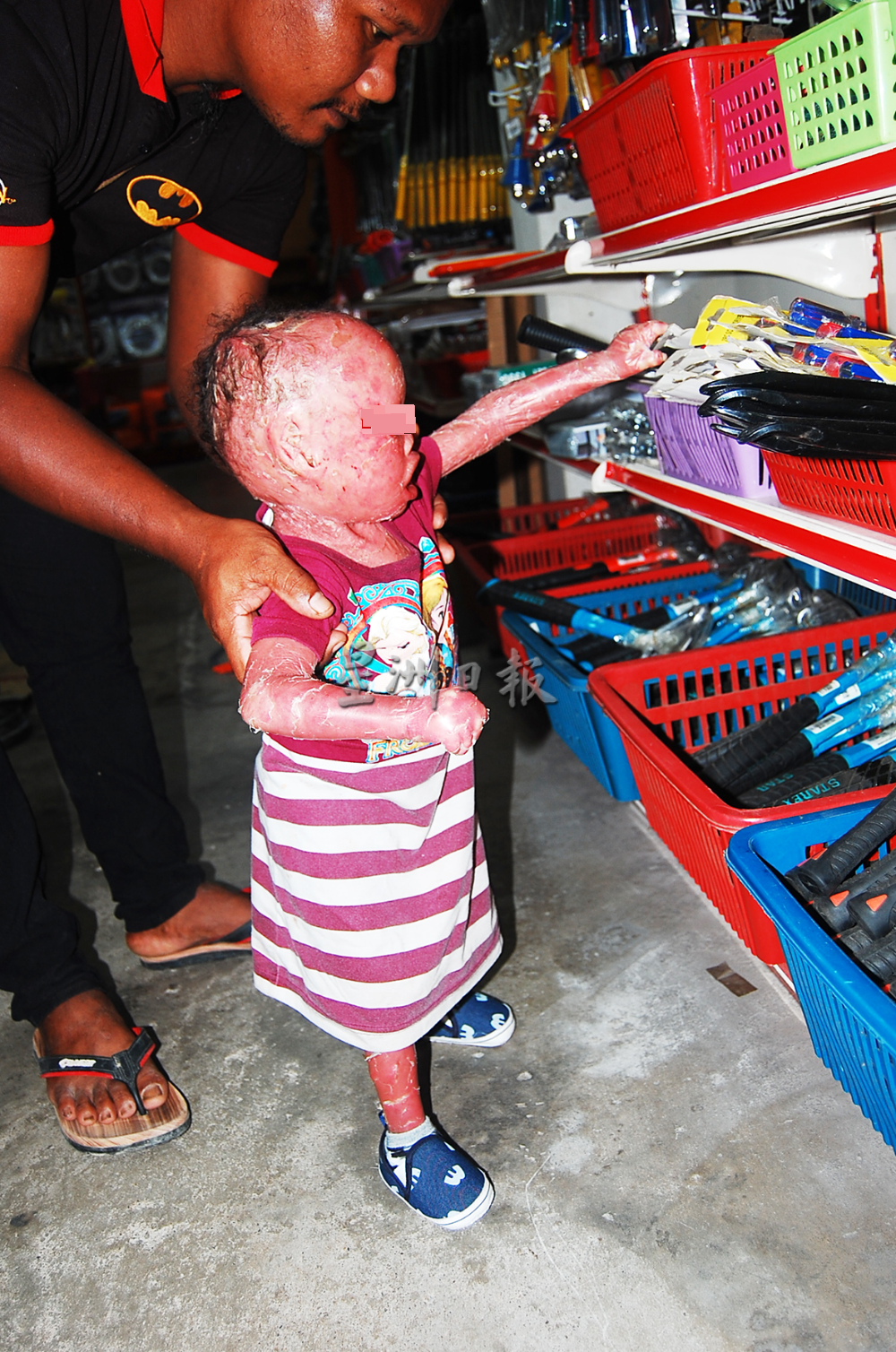 全身红通通,身体如裹保鲜膜,令人心酸的原住民女孩