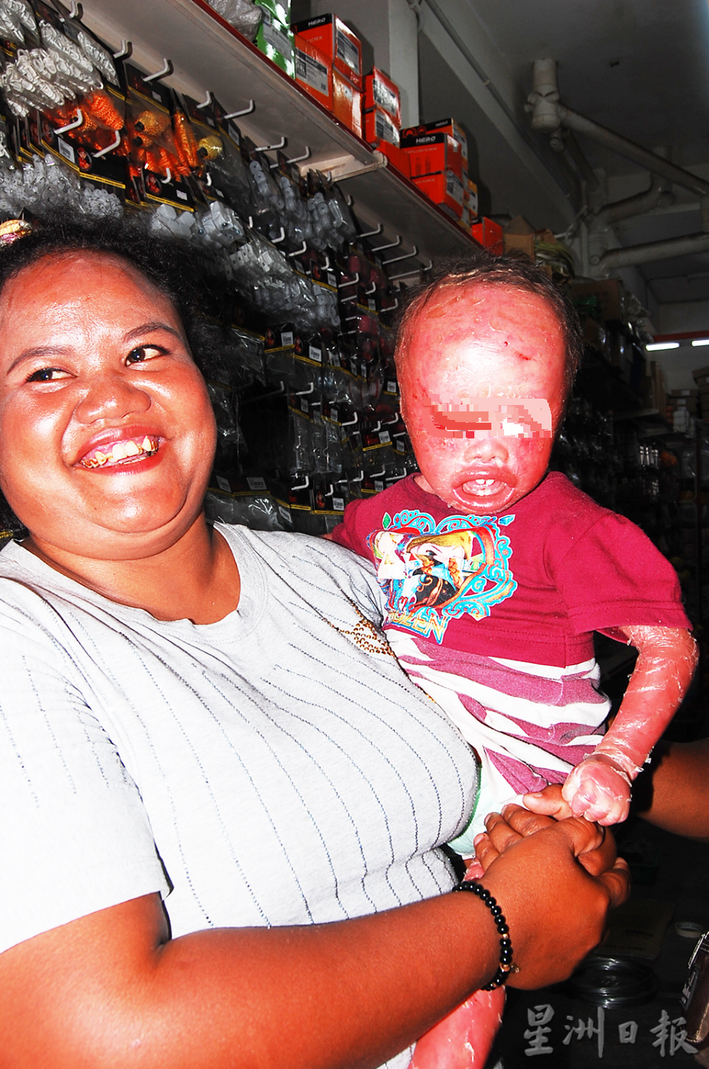 全身红通通,身体如裹保鲜膜,令人心酸的原住民女孩