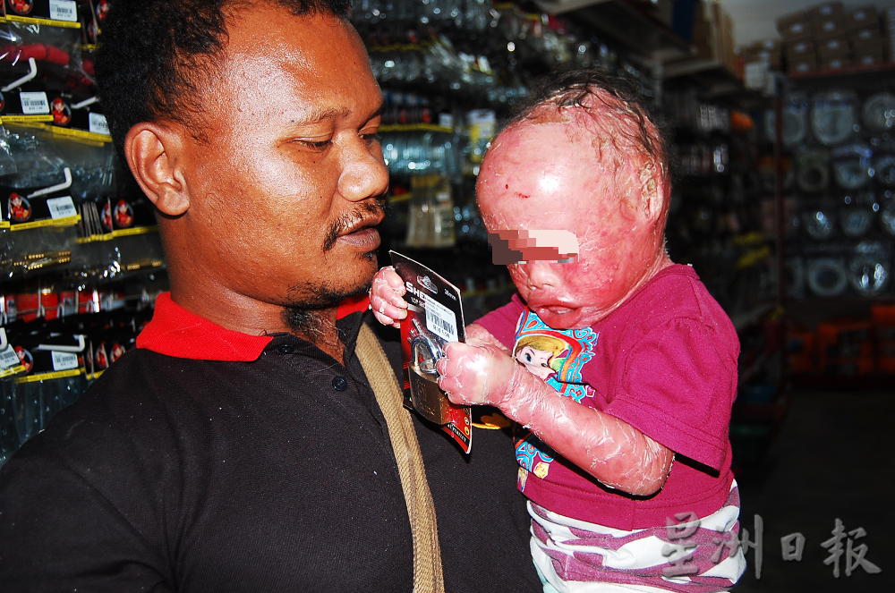 全身红通通,身体如裹保鲜膜,令人心酸的原住民女孩