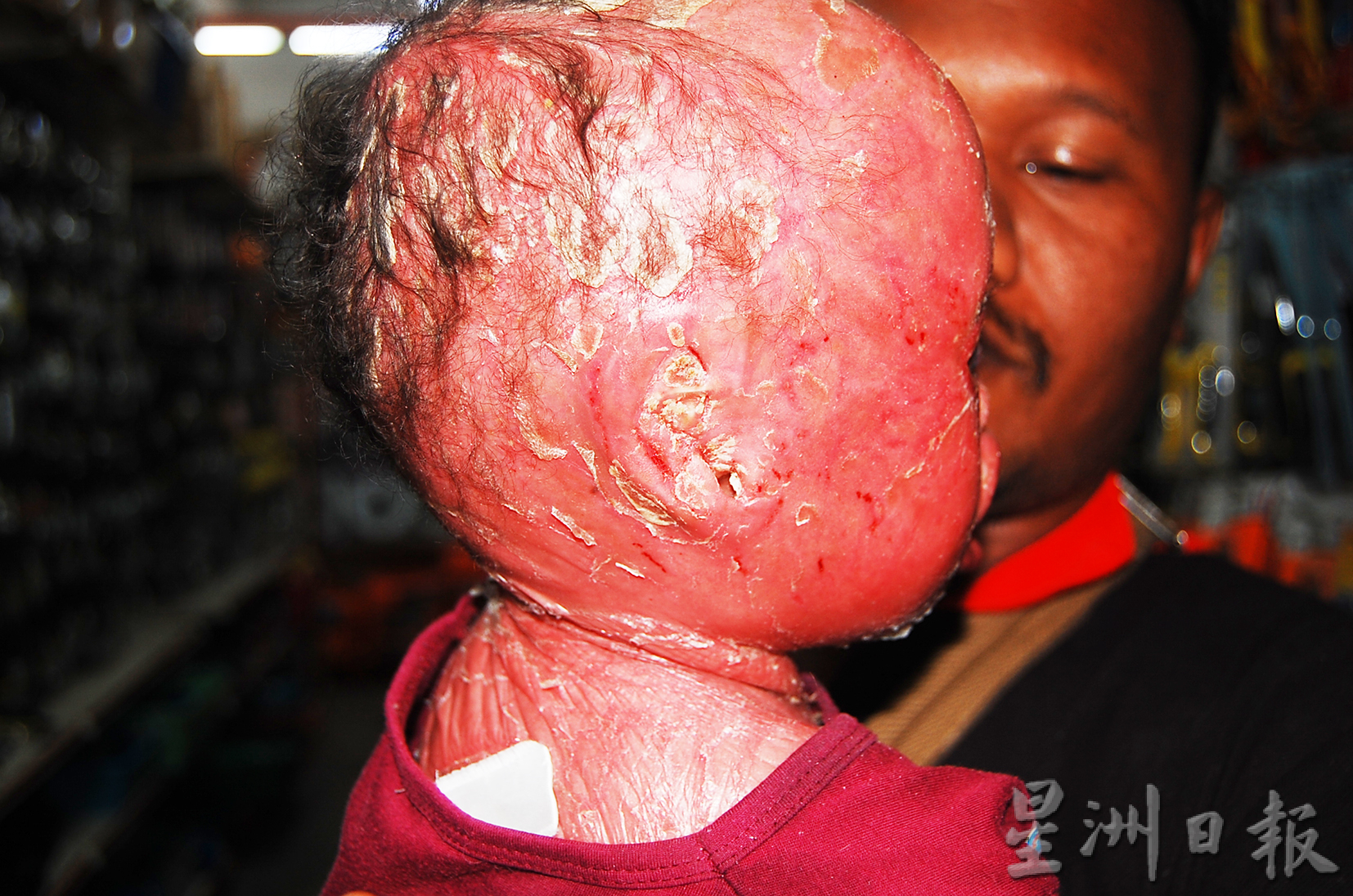 全身红通通,身体如裹保鲜膜,令人心酸的原住民女孩