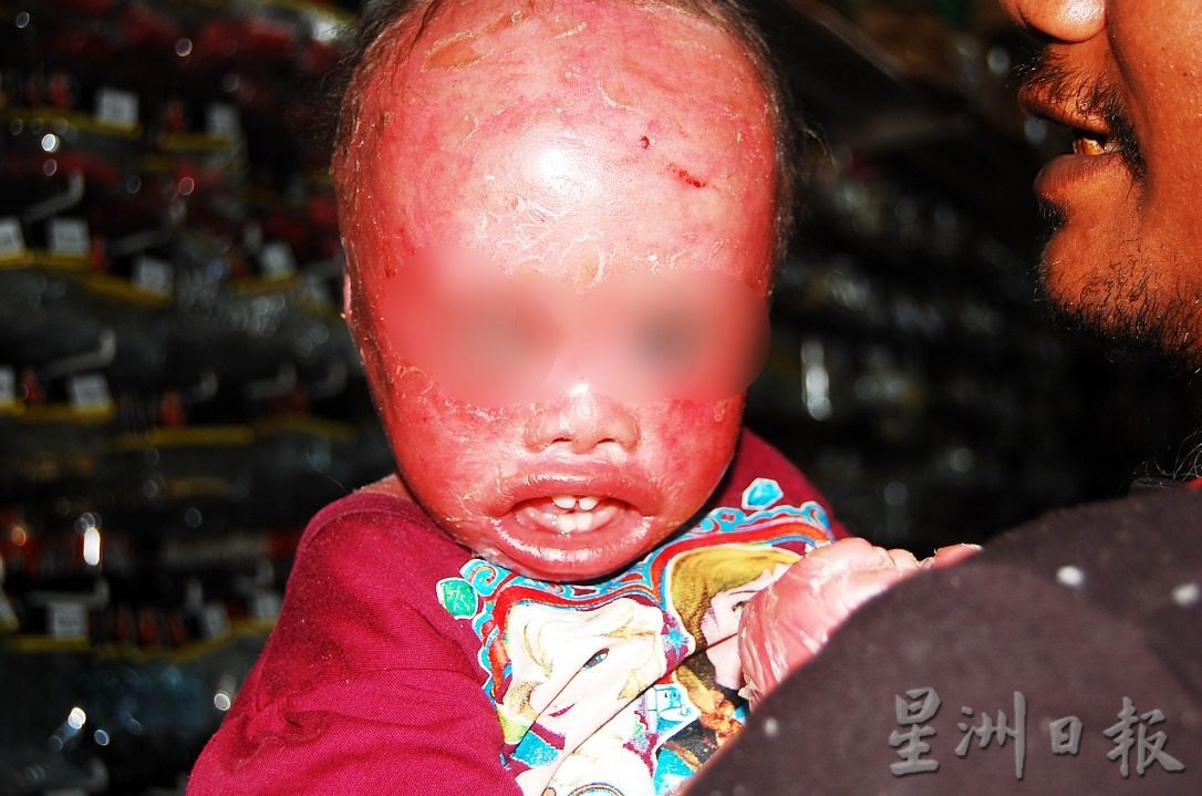 全身红通通,身体如裹保鲜膜,令人心酸的原住民女孩