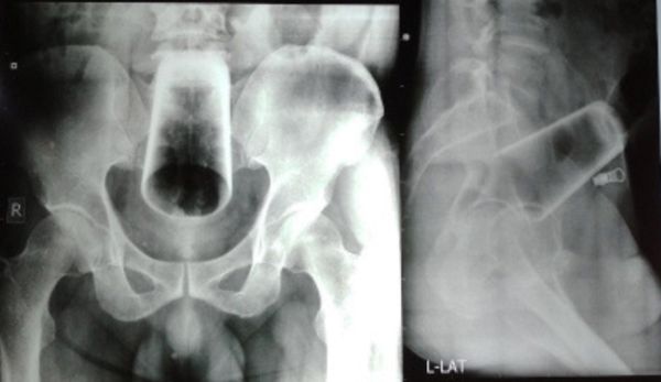 尼泊尔人夫喝醉“酒杯卡肛门3天” 谎称便秘急求医