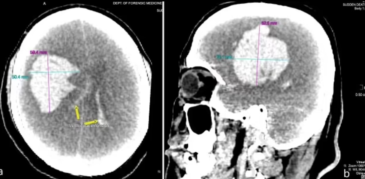 男约砲吃壮阳药喝酒助性 高潮后脑部「绝顶炸裂」爆血升天