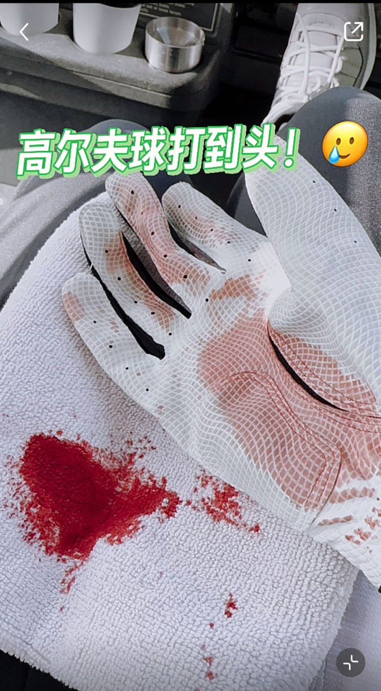 遭高尔夫球砸破头  孙耀威晒5公分血痕