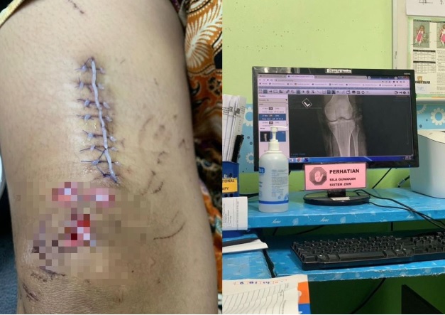 骑摩托被车撞致骨裂 少女:车主没车险 我不能索赔