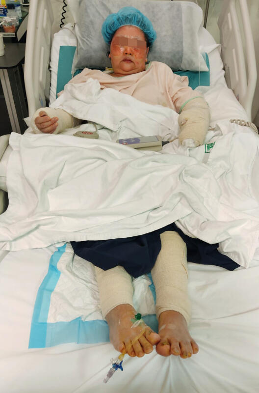 (已签发)柔:狮城二三事:煤气灶爆炸起火 女助手成火人全身25%烧伤