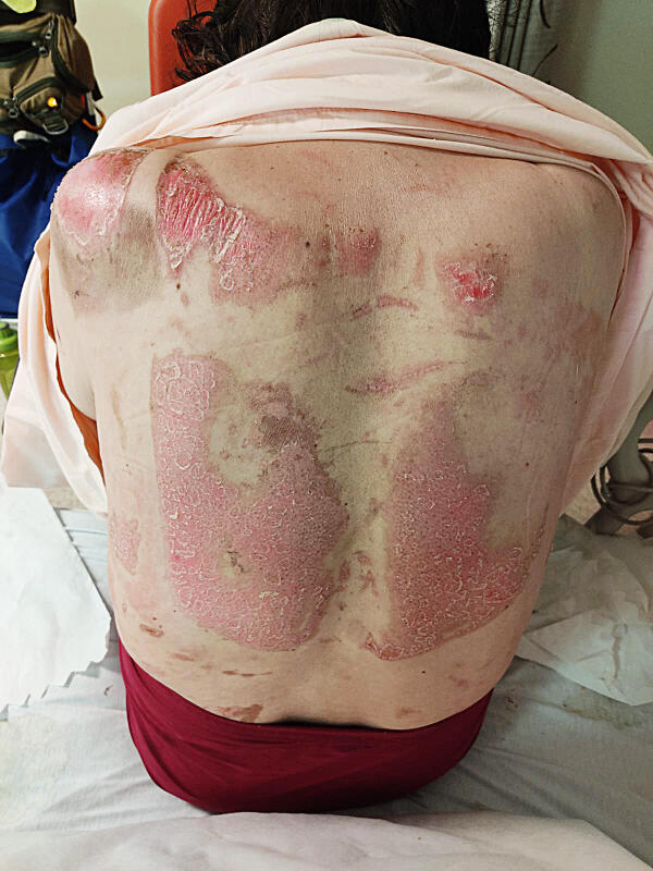 (已签发)柔:狮城二三事:煤气灶爆炸起火 女助手成火人全身25%烧伤