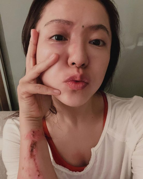 丁当烫伤后首晒自拍 每天跟伤口说谢谢