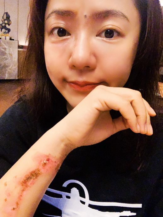 丁当烫伤后首晒自拍 每天跟伤口说谢谢