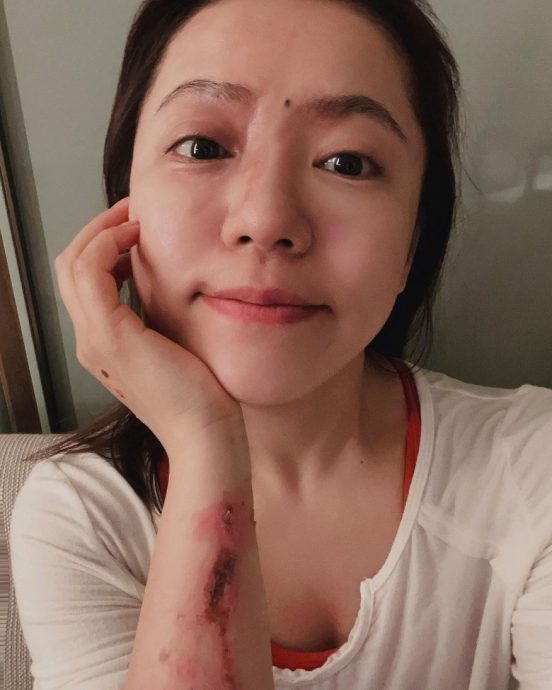 丁当烫伤后首晒自拍 每天跟伤口说谢谢