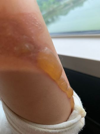 丁当煮食做1件事出意外 左眼遭烫伤肿到睁不开