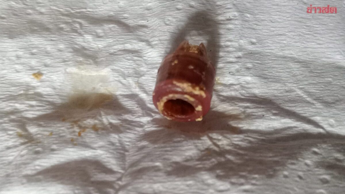 医生都说是鼻窦炎 鼻子飘异味惊揭真相