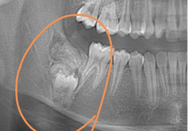 女童牙长不齐去矫正 竟照出牙齿下长肿瘤