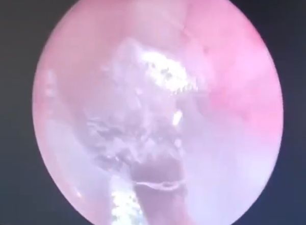 她耳鸣听力下降求诊 耳内塞满白丝成蜘蛛巢穴