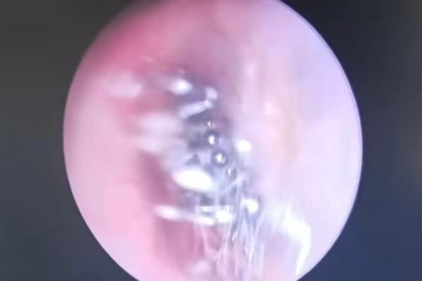 她耳鸣听力下降求诊 耳内塞满白丝成蜘蛛巢穴