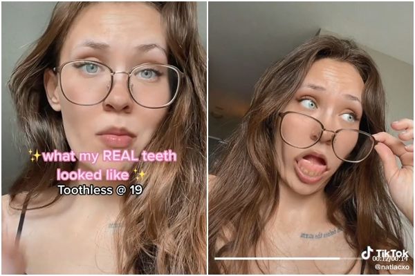 少女胃溃疡呕完就刷牙　19岁牙坏光被迫戴假牙