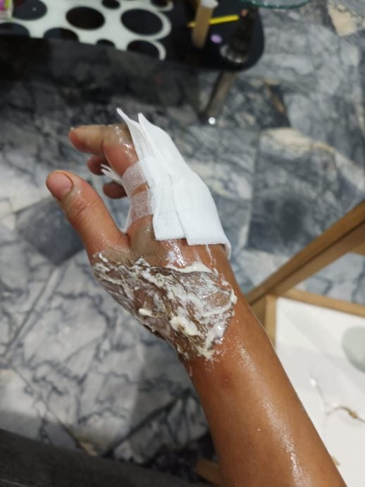 忘了厨房开火被热油烫伤 女子:右手掌皮和肉立刻硬掉