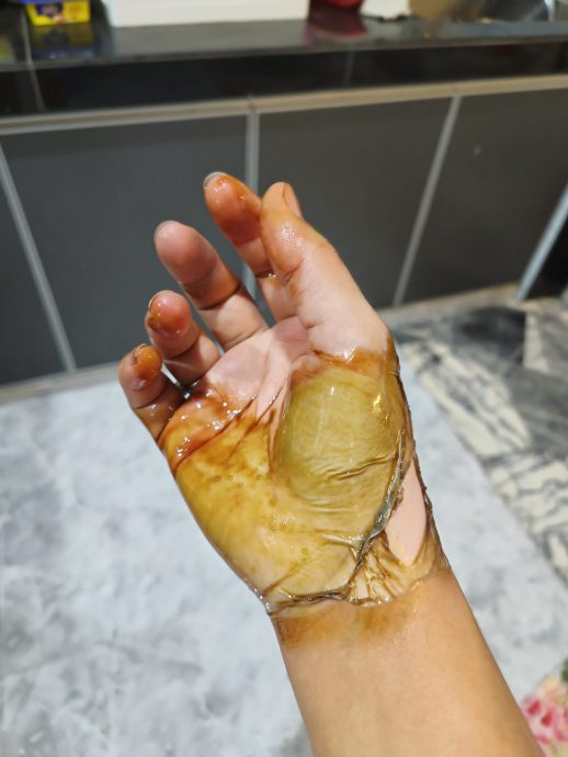 忘了厨房开火被热油烫伤 女子:右手掌皮和肉立刻硬掉