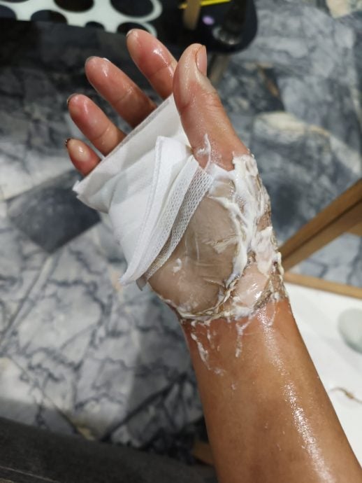 忘了厨房开火被热油烫伤 女子:右手掌皮和肉立刻硬掉