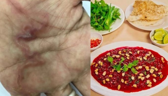 拚图)越南女食生血「啫喱」险死 寄生虫皮肤下乱爬兼大脑筑巢