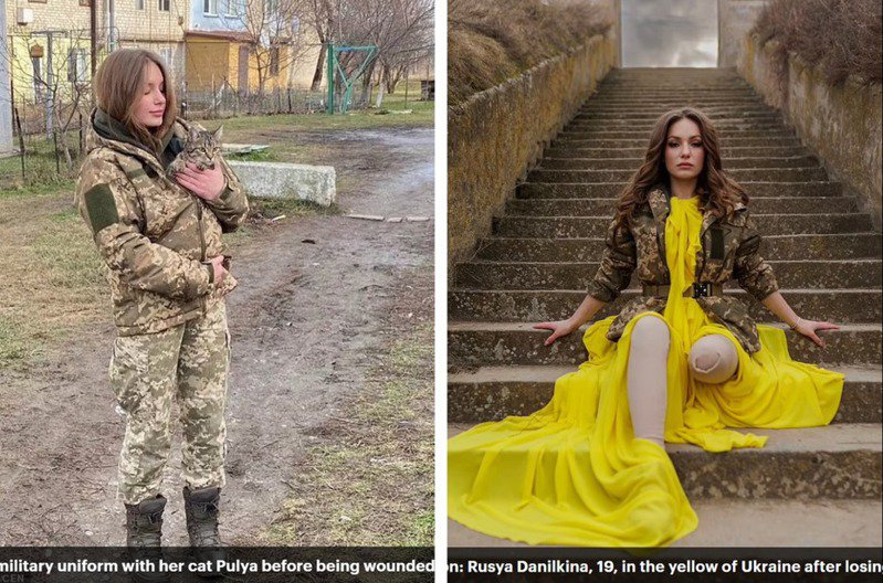 拼盘／抱膝惊觉小腿不见了　19岁乌克兰女兵勇敢面对断肢：不悔参战