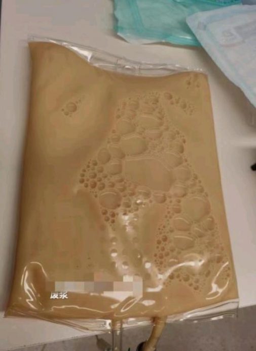 拼盘／老妇食乳猪后腹痛难忍　血液滤出近2000毫升油浆