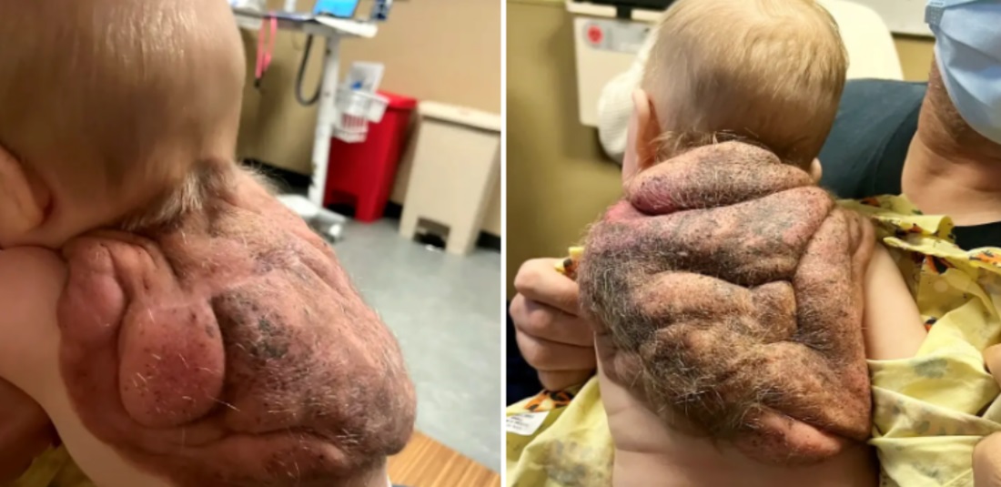 新生儿发生率约1% 男婴背长肿块如忍者龟