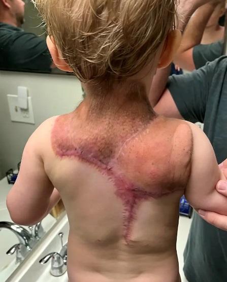 新生儿发生率约1% 男婴背长肿块如忍者龟