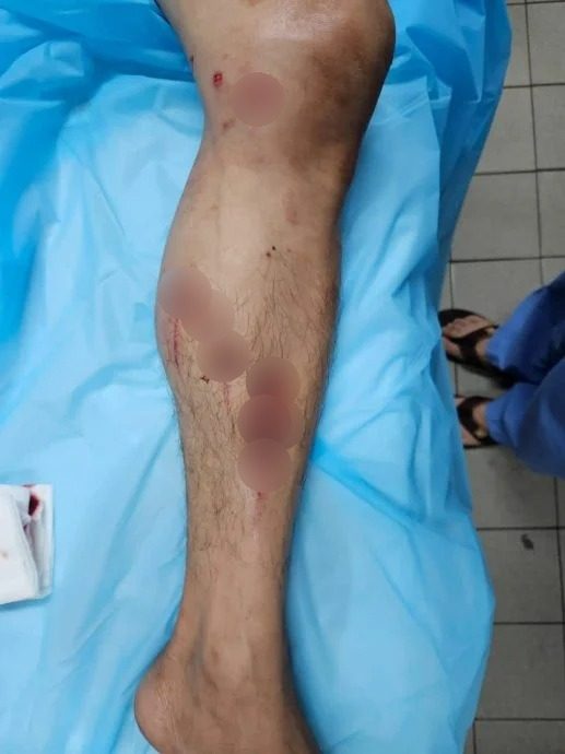 男子在河中捕捉虾子时被鳄鱼攻击及咬伤左小腿