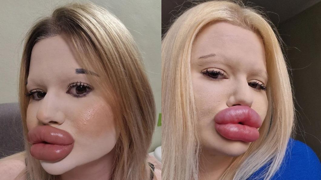 砸2万英镑动43次手术!正妹变“世界最大嘴唇”吐心声:想脱单