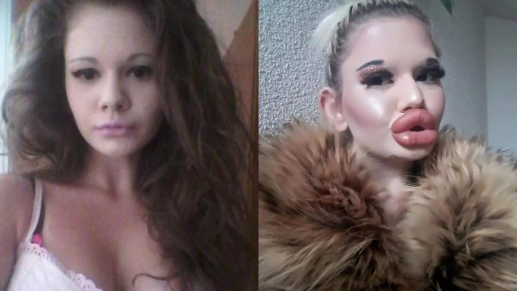 砸2万英镑动43次手术!正妹变“世界最大嘴唇”吐心声:想脱单