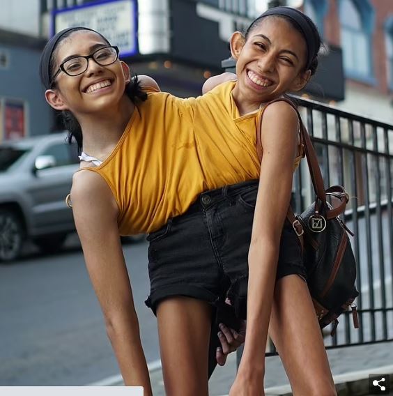 连体双胞胎姐妹恋爱2年多 三人行没问题