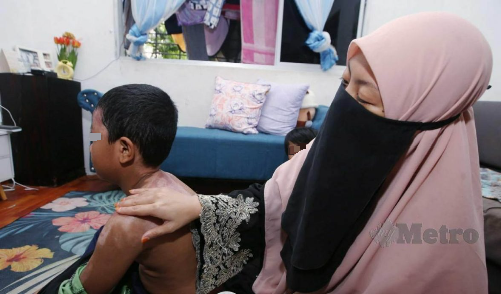 邻居用酸性苏打粉通水管·9岁男童眼睛身体惨被烧伤!