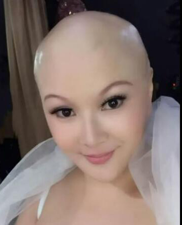(已签发)柔:狮城二三事:化疗头发掉光 刘心玲目前由姐照顾