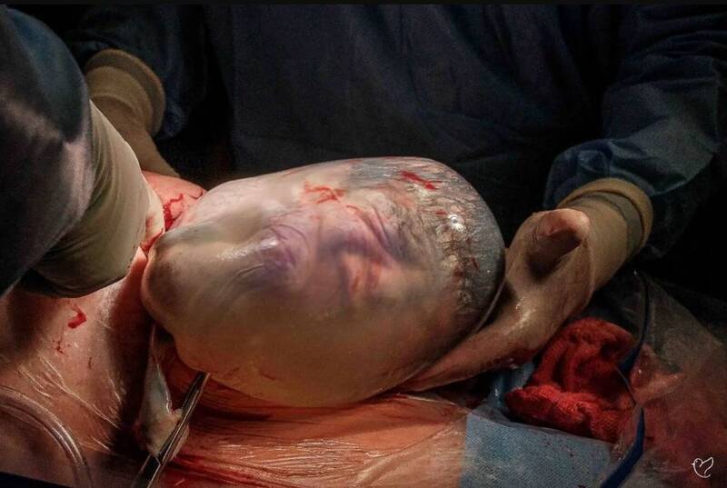 几率仅8万分之一!求子多年终怀双胞胎 她生下“人鱼宝宝”