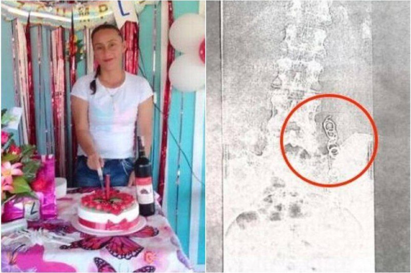 妇女结扎术后疼痛难眠 医生11年才找到原因!