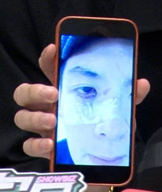 打球被随陌生人指甲戳眼  柯震东眼睑缝7针