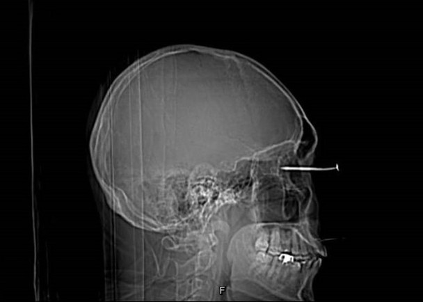 拚盘／男子钉床板操作不慎　6公分钉反弹直插眼球