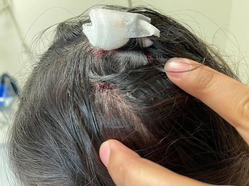 柔:狮城二三事:单亲妈妈被货车撞飞 生活大受影响