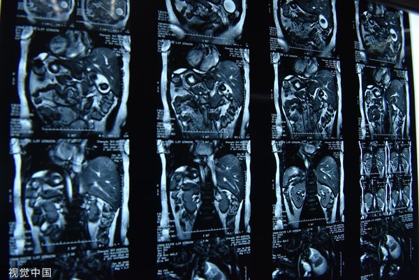武汉出现罕见“镜面人”宝宝 百万分之一几率“内脏左右相反”
