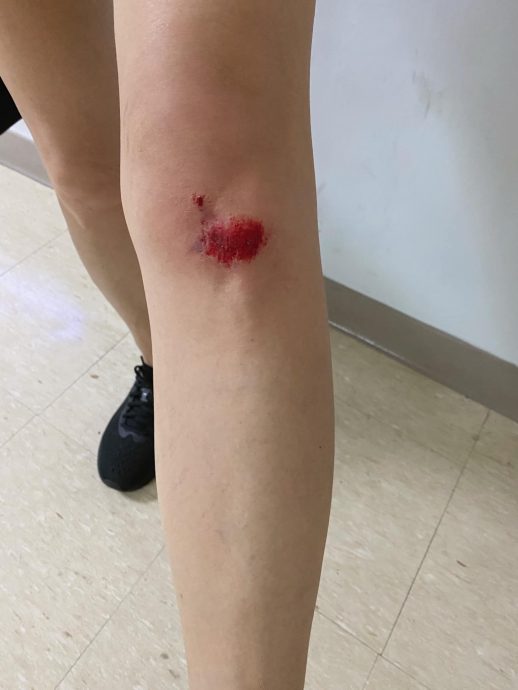 祸从天降! 辛晓琪被高处摔下阿伯压伤