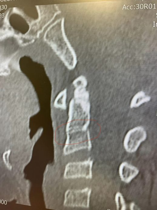 (全国版)家长指控孩子踢球时遭故意致伤 不满校方以“意外”为由要求不追究