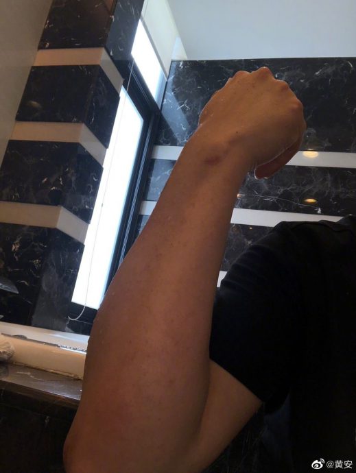 黄安家发生煤气爆炸 弟弟手臂灼伤厨房一片狼藉