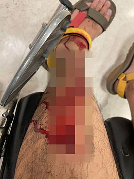 (已签发)柔:狮城二三事:遛狗遭野猪攻击 男子脚缝20针